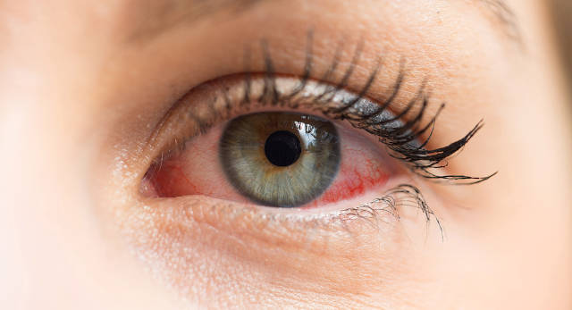 ССГ - синдром сухого глаза