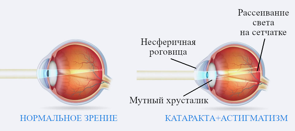 Причины ухудшения зрения при астигматизме и катаракте