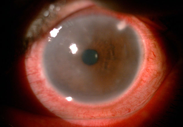 Туман после операций на глазах - удаления катаракты и лазерной коррекции зрения