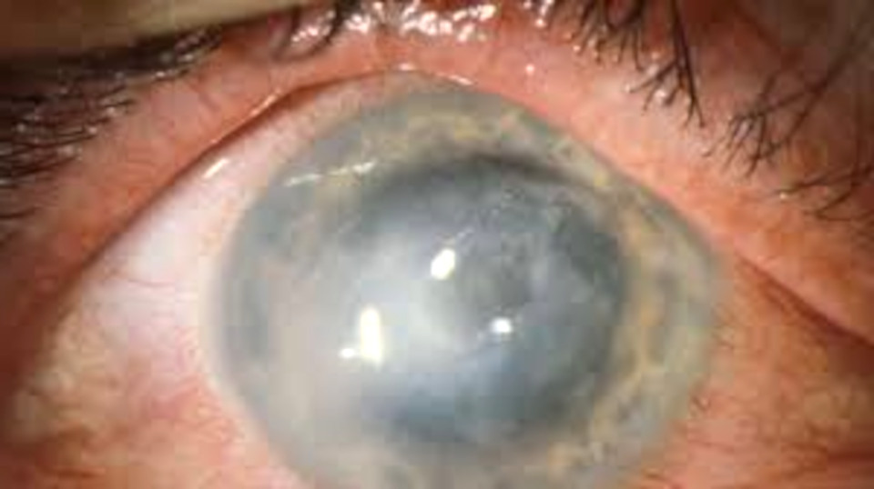 Красные глаза и боль после сна в контактных линзах