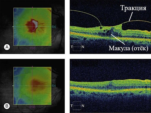 Оптическая когерентная томография (ОКТ) в диагностике витреомакулярного тракционного синдрома